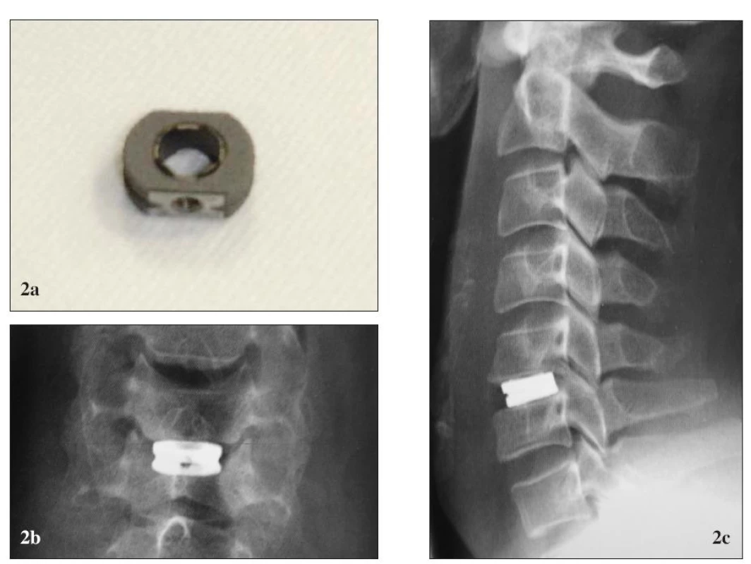 Titánová náhrada medzistavcovej platničky Cespace® (Aesculap). (a) pred implantáciou, (b) po implantácii, RTG (b1) predná a (b2) bočná projekcia