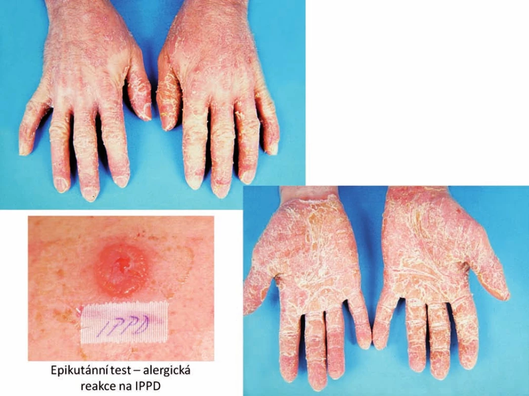 Eczema contactum – antioxidant IPPD (guma hadice) – atopická baze – obráběč kovů