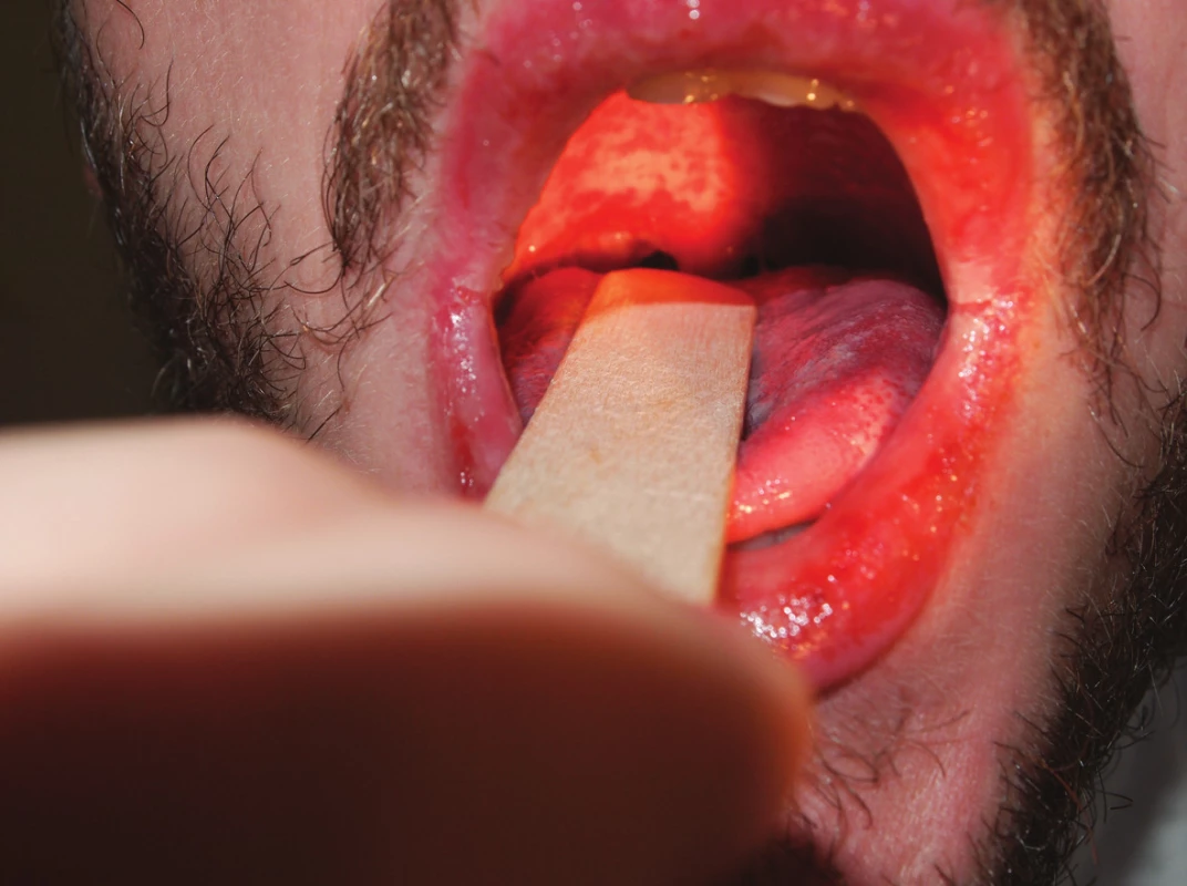 Léze v ústní dutině. Jsou patrné eroze rtů, jazyka a sliznice patra.
