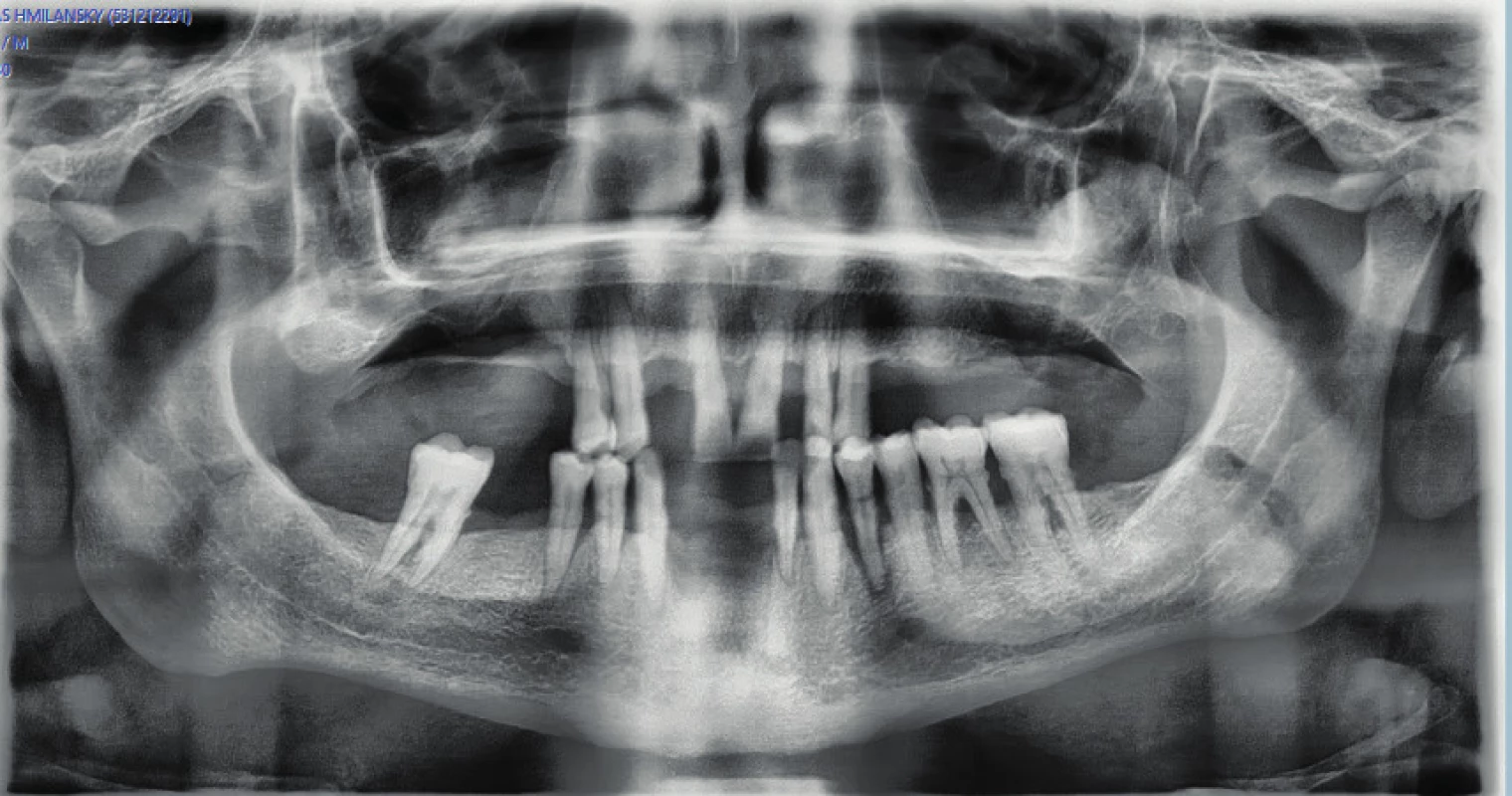 Parodontitída na OPG snímke