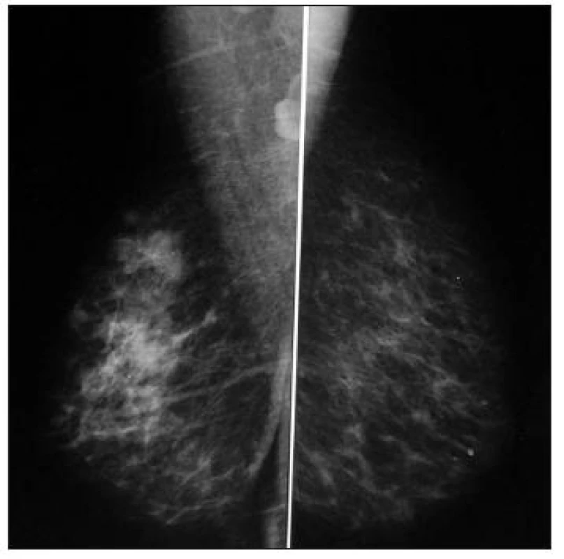 Mamografie pravého prsu
Fig. 2. Mamography of the right breast