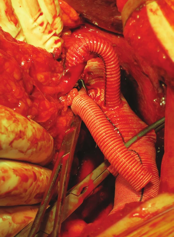 Náhrada aorty od coeliackého trunku, bypass na levou renální tepnu
Fig. 15: Aorta replacement from coeliac trunk, bypass to left renal artery