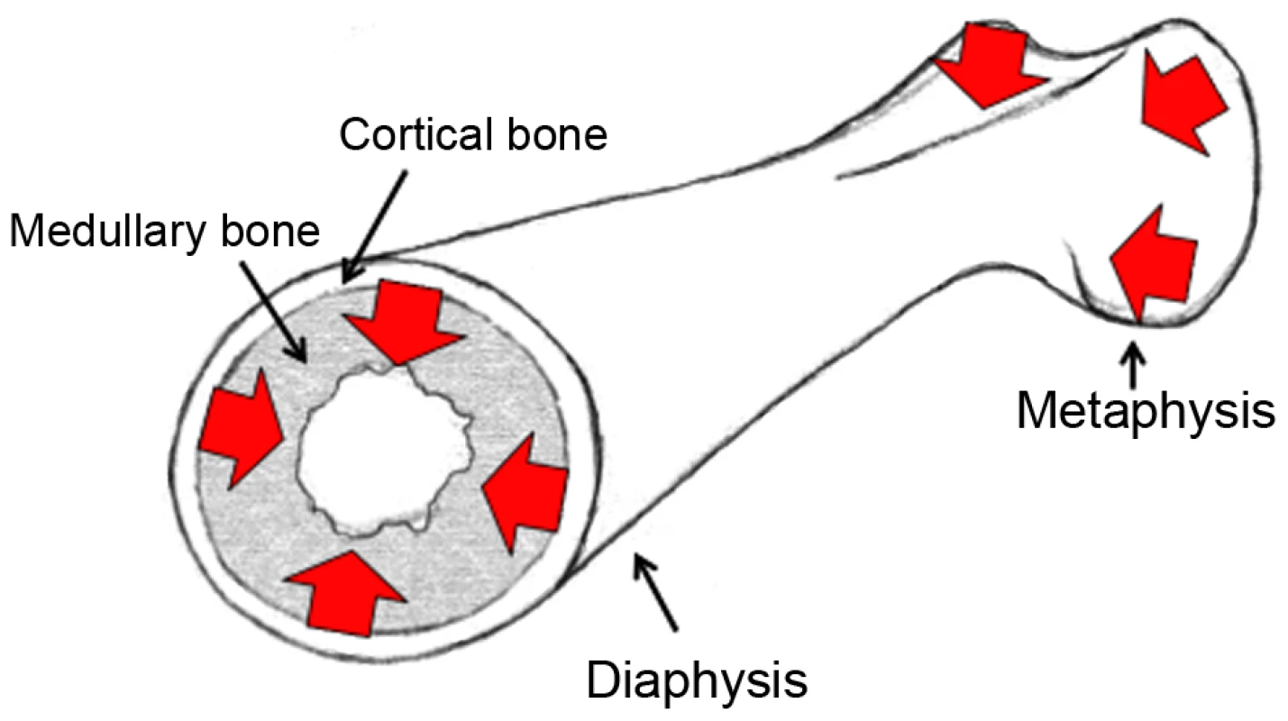 Cartoon of a female femoral bone.