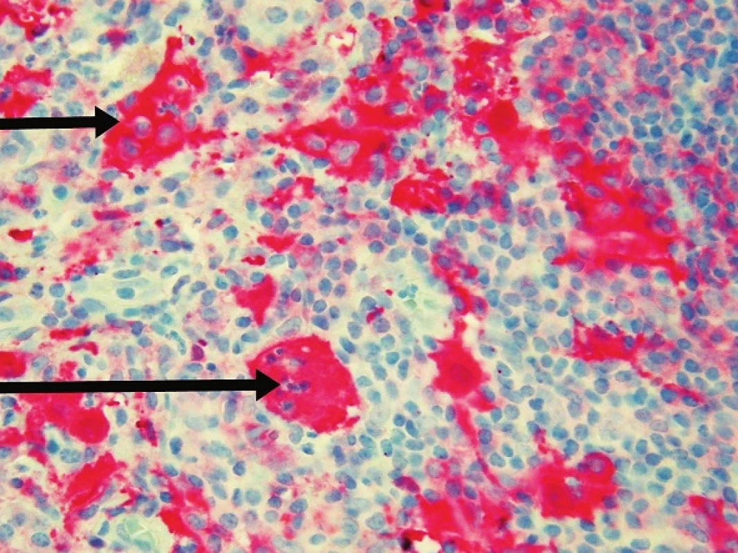 Histiocyty jsou také S100 pozitivní Emperipolesis lymfocytů (horní šipka) a polynukleárů (dolní šipka).
(původní zvětšení 200krát)