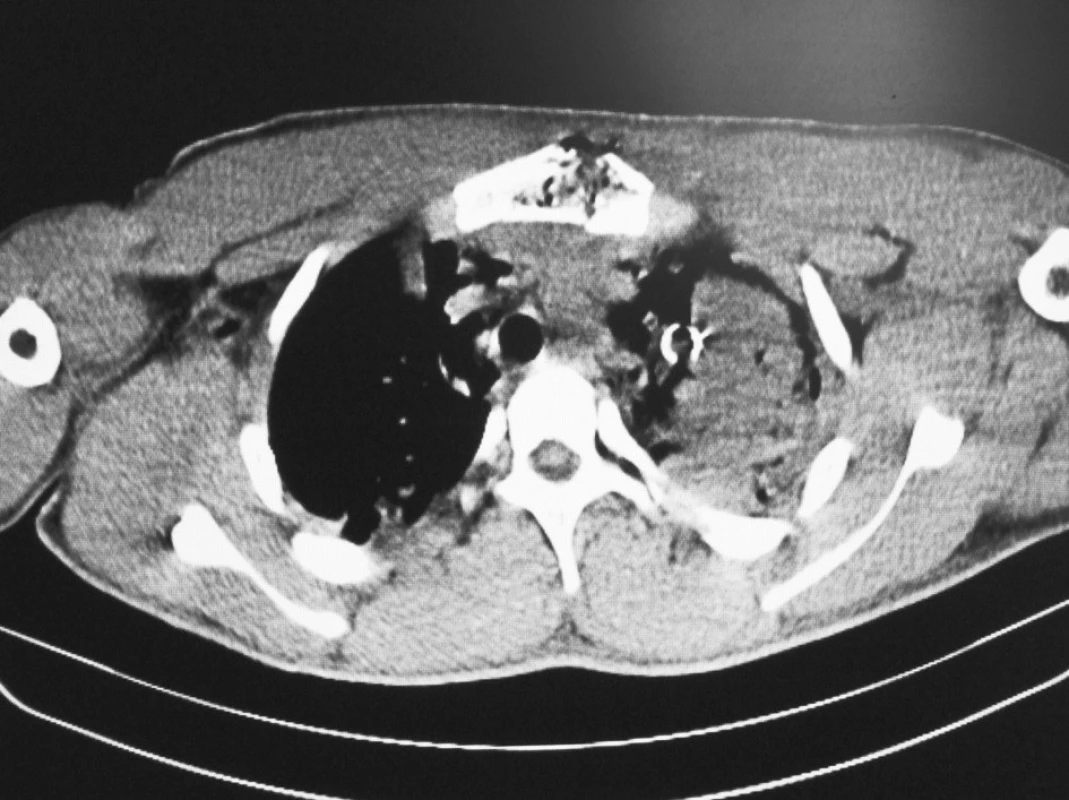 CT s nálezem těžké kontuze apexu levé plíce a zlomeninou sterna
Fig. 1. CT picture with serious contusion of apex of the left lung and sternal fracture