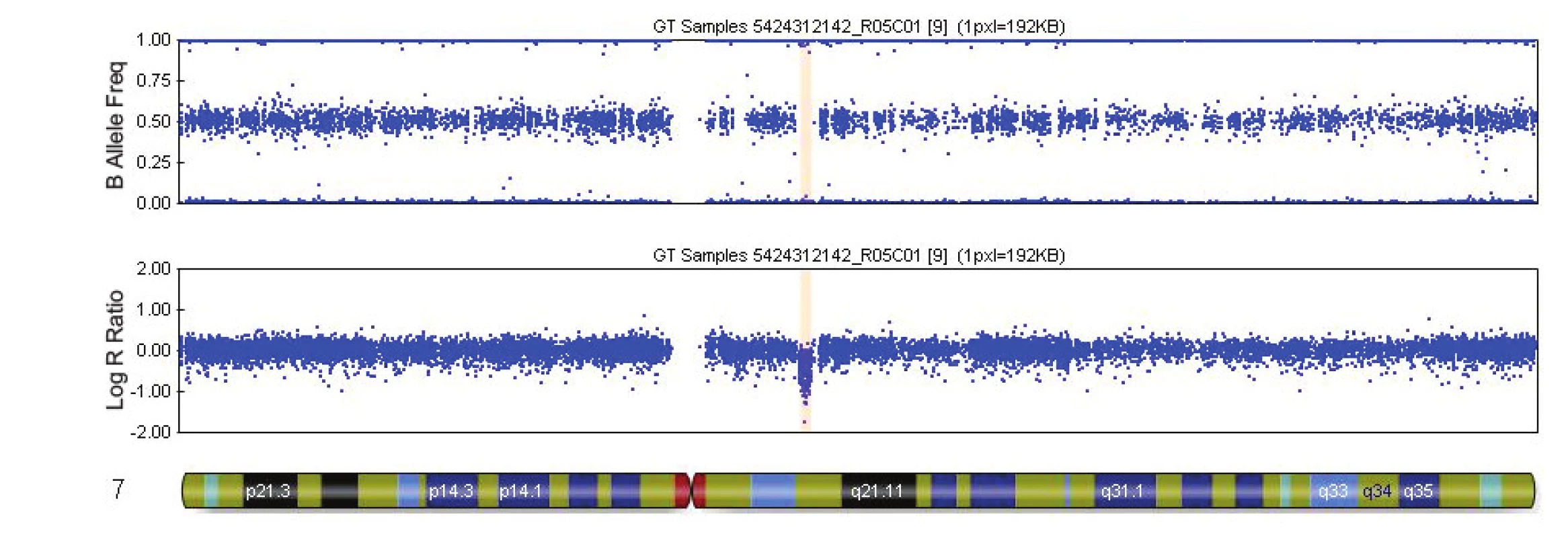 Výsledek vyšetření metodou SNP array – mikrodelece na chromozomu 7 (případ č. 9, tab. 4). Mikrodelece 7q11.23 (okrový blok) o velikosti 1.4 Mb u plodu se závažnou srdeční vadou a vývojovou asymetrií. Mikrodelece překrývá oblast pro Williamsův-Beurenův syndrom.