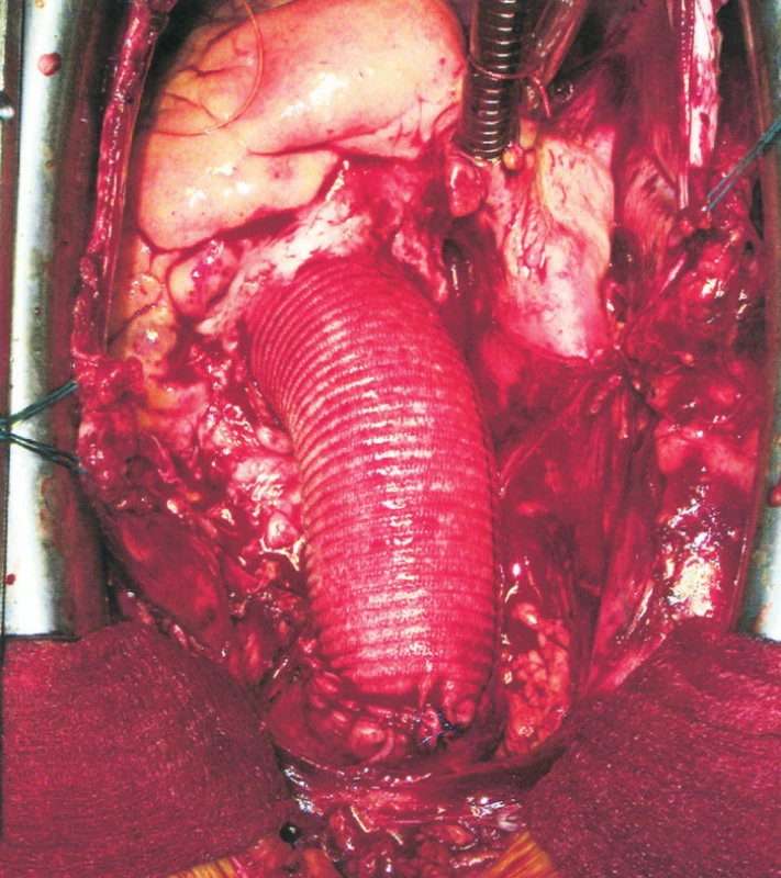 Vzestupná aorta nahrazena cévní protézou
Fig. 3. The ascendidng aorta, replaced with a vascular prosthesis