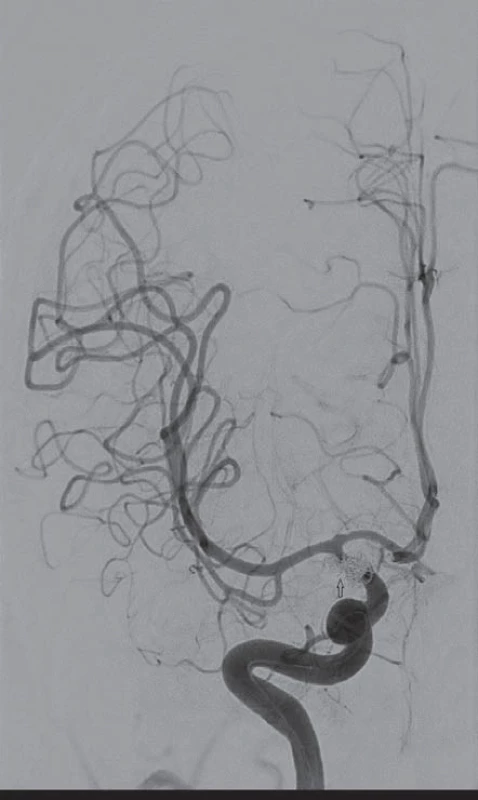 Šestapadesátiletá nemocná, klinicky: Hunt-Hess II, stupeň krvácení: Fischer I. Digitální subtrakční angiografií verifikovány tři aneuryzmata terminálního úseku vnitřní karotidy vpravo. Ošetření aneuryzmat endovaskulárně (coil).