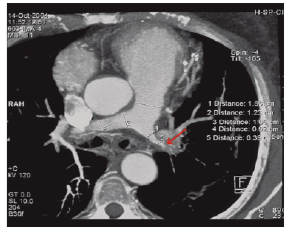 MIP rekonstrukce CT hrudníku: kritická stenóza levé a. pulmonalis (šipka).