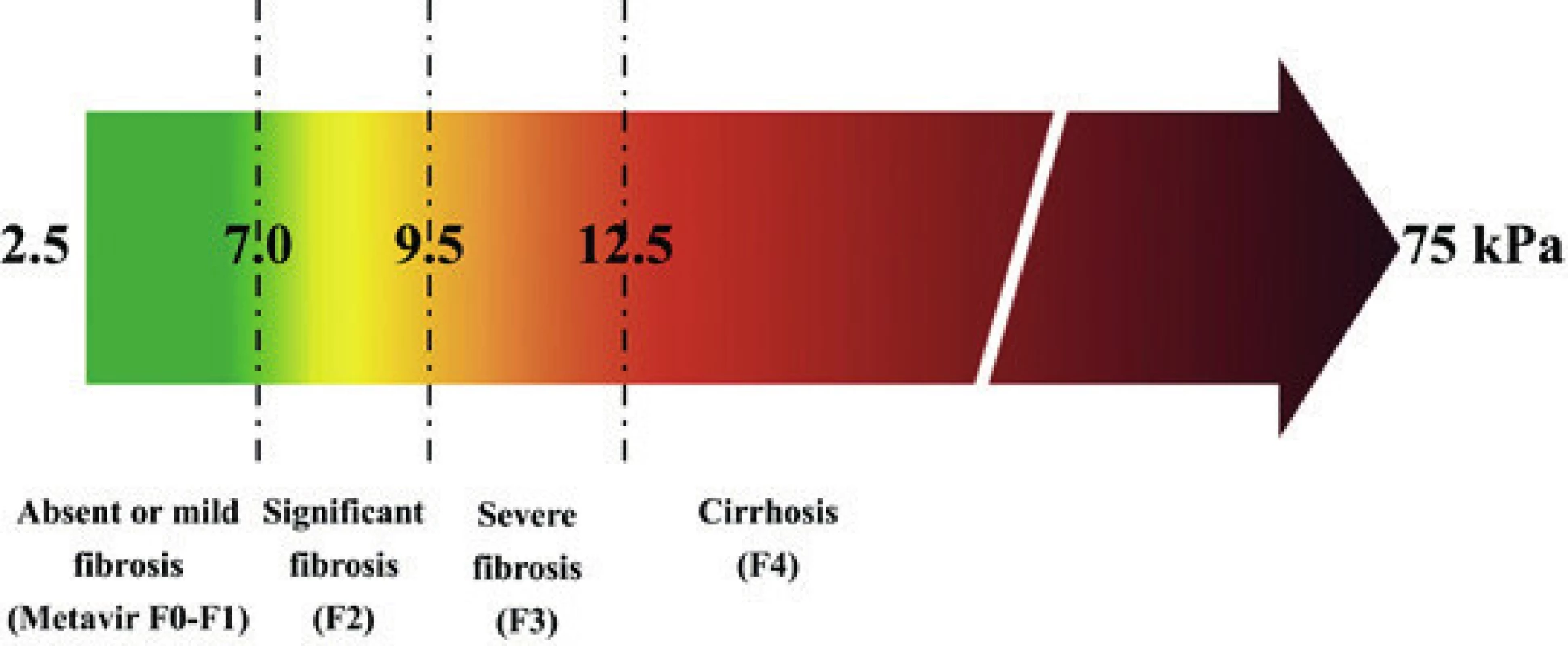 Stadia jaterní fibrózy podle elastografie (F 4 odpovídá cirhóze)