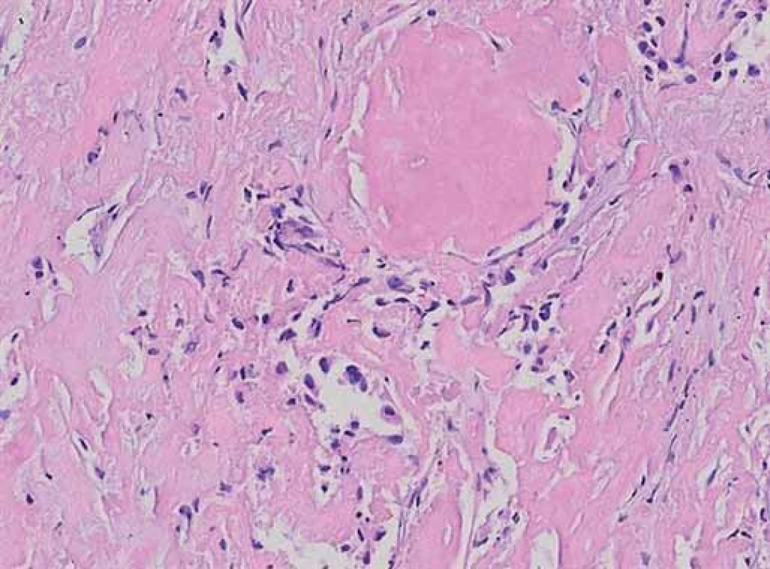 Metastáza medulárního mikrokarcinomu do plic. Mezi masami amyloidu jsou nenápadné skupinky medulárního karcinomu.