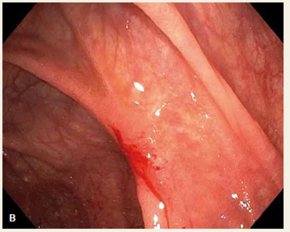 Endoskopický obraz hojícího se vředu na dně céka (A) a v ascendentu za 6 týdnů od krvácivé příhody (B).