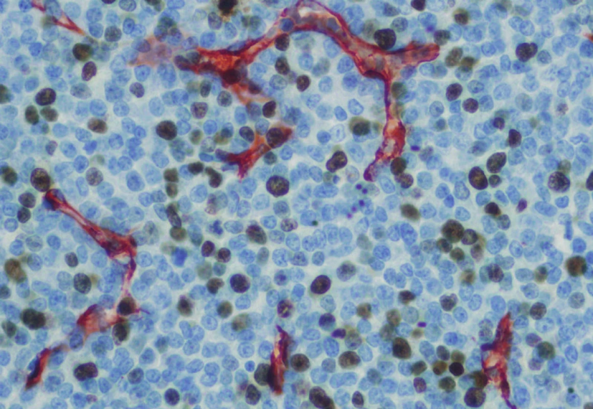 MM nodulární infiltrát, dvojí imunohistochemické barvení, CD34 – červený chromogen, Ki67 – hnědý chromogen, 400krát