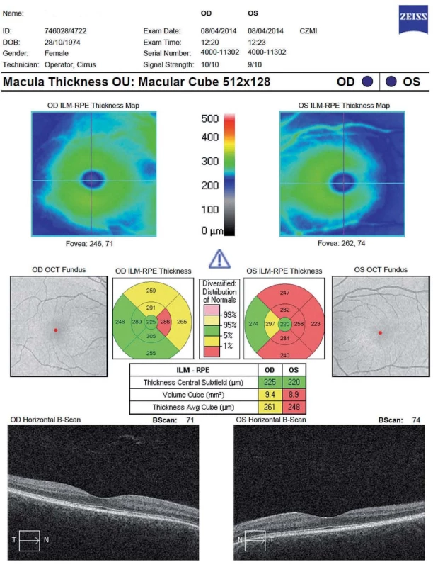 Vyšetření celkového makulárního objemu (Total Macular Volume; TMV) – patologický nález (Cirrus OCT HD), na levém oku stav po optické neuritidě.

