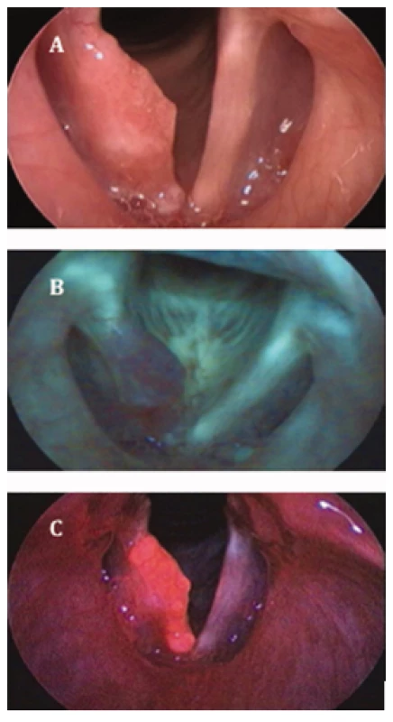 Obr. 1  Porovnání zobrazení spinocelulárního karcinomu pravé hlasivky v bílém světle (A), v autofluorescenční (B) a PDD endoskopii (C).