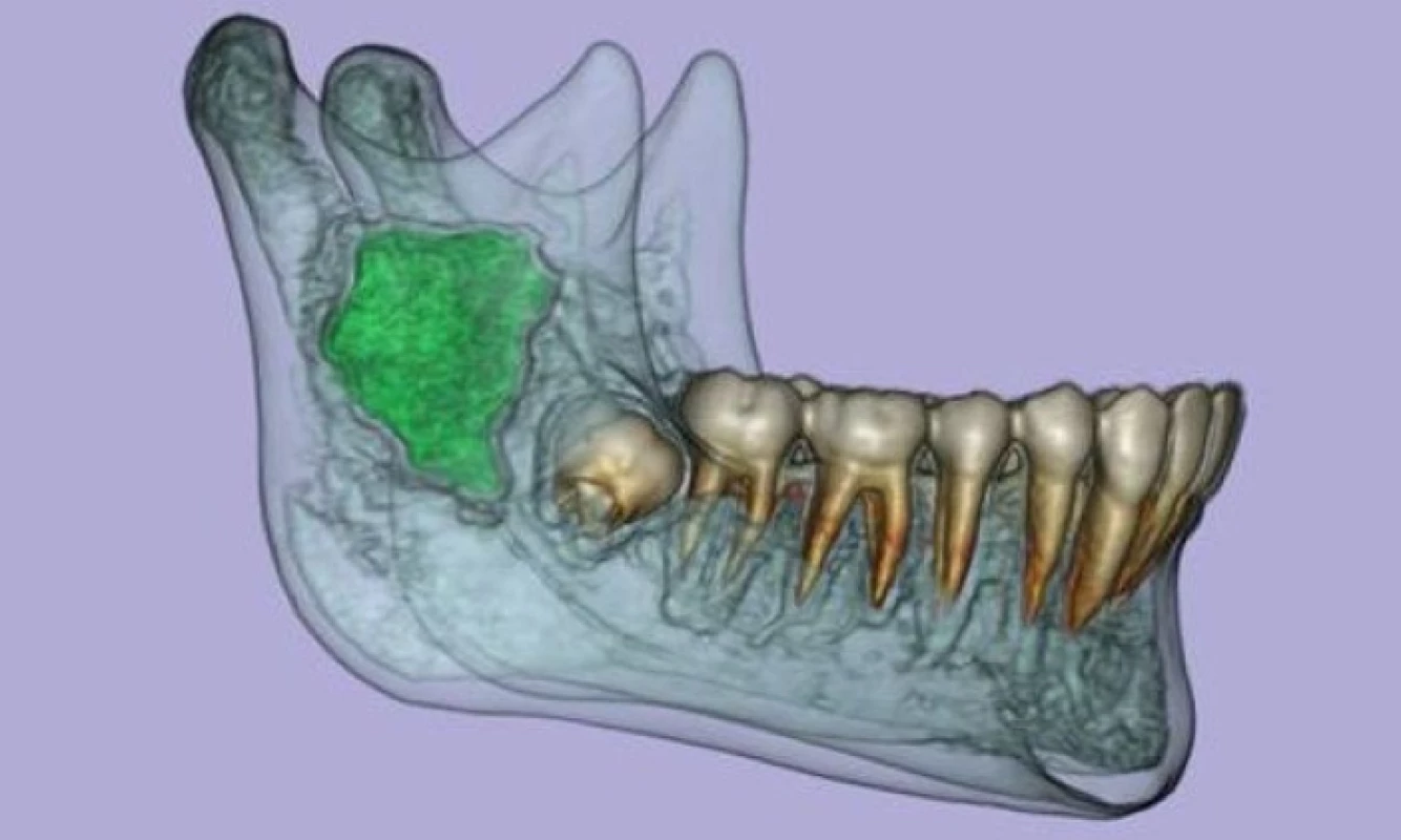 3D CT rekonstrukce cysty