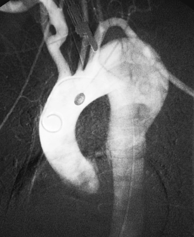 DSA obraz aneuryzmatické dilatace disekované hrudní aorty
Pic. 6. A DSA view of aneurysmal dilation of the dissected thoracic aorta