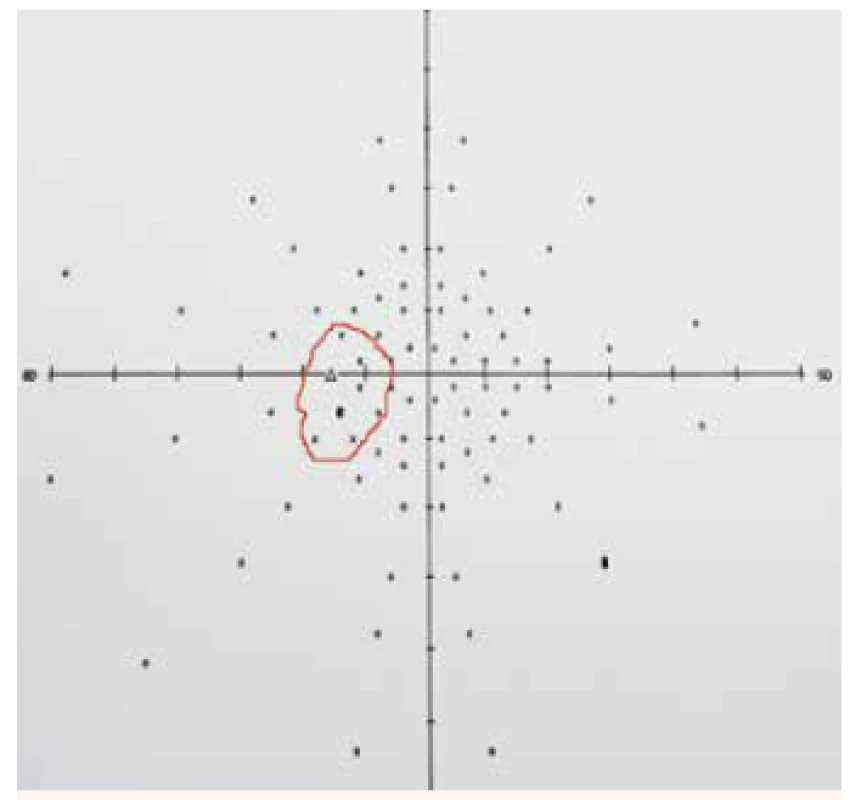 Vyšetření zorného pole levého oka na perimetru Full field 81 zobrazující rozšířený Mariottův bod u pacienta s edémem terče zrakového nervu při idiopatické intrakraniální hypertenzi na levém oku – rozšíření naznačeno červeným obrysem. Vlevo od centra zorného pole je trojúhelníková značka označující v zorném poli Mariottův bod (slepou skvrnu) na obrázku obklopený křížky (značícími relativní výpady na perimetru) a černým čtverečkem (vyjadřujícím absolutní výpad v zorném poli). Tyto výpady rozšiřující slepou skvrnu v zorném poli typicky provázejí edém terče zrakového nervu. Malé kroužky značí fyziologicky viděné body (podněty) při vyšetření zorného pole.