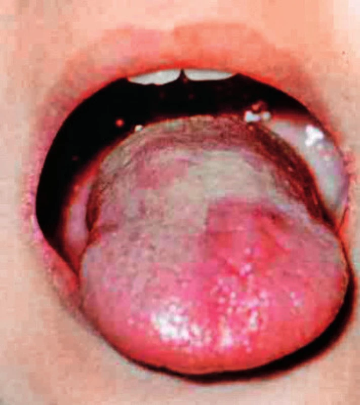 Na povrchu tela jazyka u mladých dospelých sú prítomné väčšie políčka červenej farby. V ich okruhu došlo k atrofii filiformných papíl.