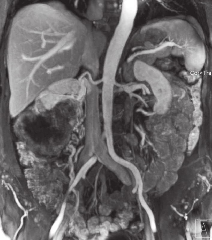 Žena s objemným tumorem vycházejícím z dolního pólu pravé ledviny s generalizací. Před cytoredukční nefrektomií provedena MRA. 2A – ukazuje arteriální fázi, 2B – venózní, při které je mj. dobře patrná mohutná drenáž z tumoru do ovarické žíly
Fig. 2. Woman with large tumour of the lower part of the right kidney T3aN0M1. 2A – arterial phase, 2B – venous phase (aberrant veins from tumour to the ovaric vein are clearly visible)
