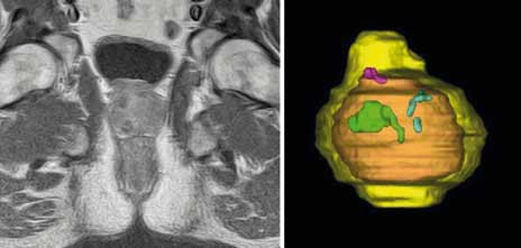 Pacient 002–006; Gd-MRI koronární řezy A. týden po léčbě, B. měsíc po léčbě, C. tři měsíce po léčbě, D. šest měsíců po léčbě; (žlutá – prostata, zelená – léze pravého laloku, modrá – léze levého laloku, oranžová – přechodová zóna, růžová – léze středního laloku).