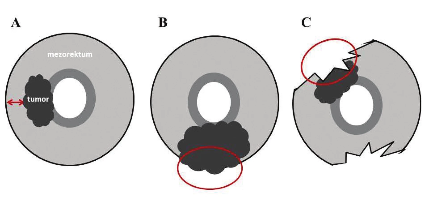 Schematické znázornenie negativity/pozitivity cirkumferenčného resekčného okraja, ktorý je nafarbený tušou a) negatívny CRM, b) Lokálne pokročilý tumor rastúci do CRM c) malý tumor dosahujúci CRM v dôsledku nekompletnej excízie mezorekta (volně podle Nagtegaala [5]). 
Fig. 1: A diagram presenting the negativity/positivity of circumferential resection margin marked with black ink a) negative CRM, b) locally advanced tumour growing into CRM, c) small tumour invading CRM as a consequence of incomplete mesorectal excision (adapted from Nagtegaal [5]).