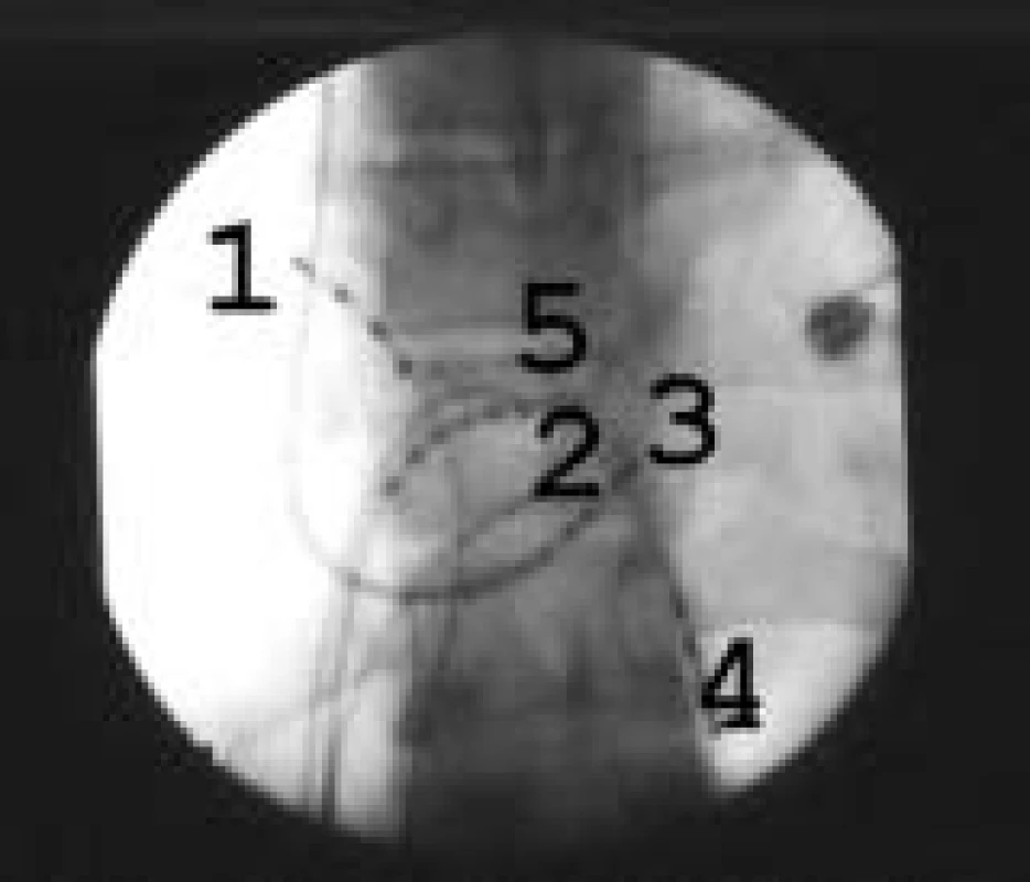 Základní postavení elektrofyziologických katétrů.
1 – HRA – horní pravá síň, 2 – H – Hisův svazek, 3 – CS – koronární sinus, 4 – RVA – hrot pravé srdeční komory, 5 – ablační katétr