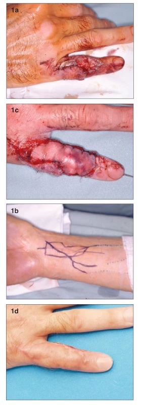 a. Defect with exposure of the proximal interphalangeal joint and loss of extensor tendon
b. Design of the venous flap on the distal forearm
c. Venous flap 2nd day post-op. Please note the degree of hyperemia is higher on the inflow (distal) part of the flap
d. Flap completely healed 1 month post-op