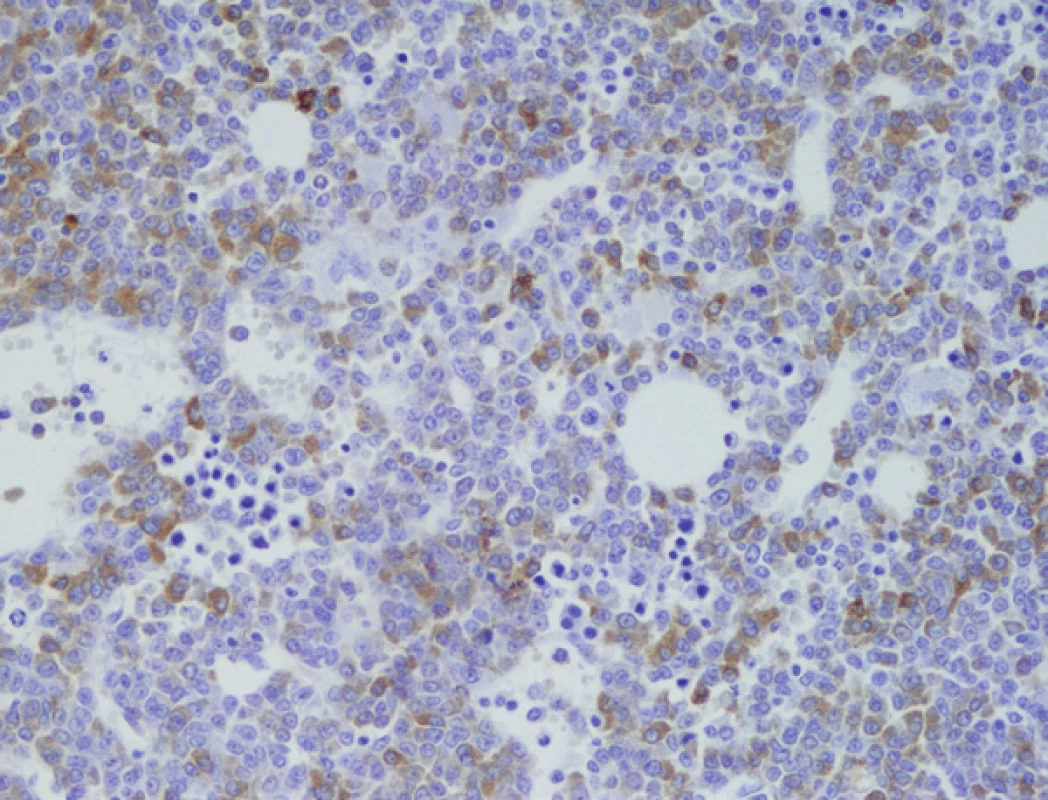 Imunohistochemické vyšetření kostní dřeně, nesekreční myelom, infiltrace nádorovými plazmocyty fokálně s pozitivitou CD79a (zvětšení 200x).