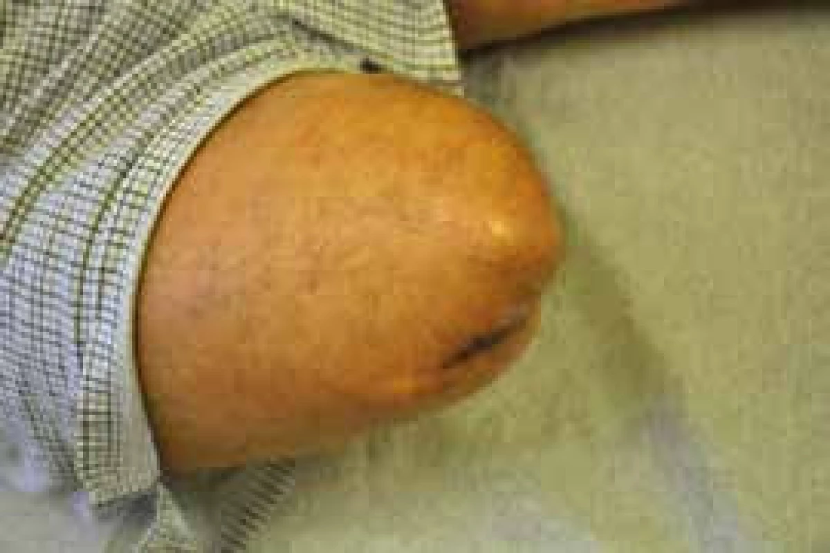 Nevhodný amputační pahýl, kost prominuje pod kůži a hrozí nekróza kůže a perforace