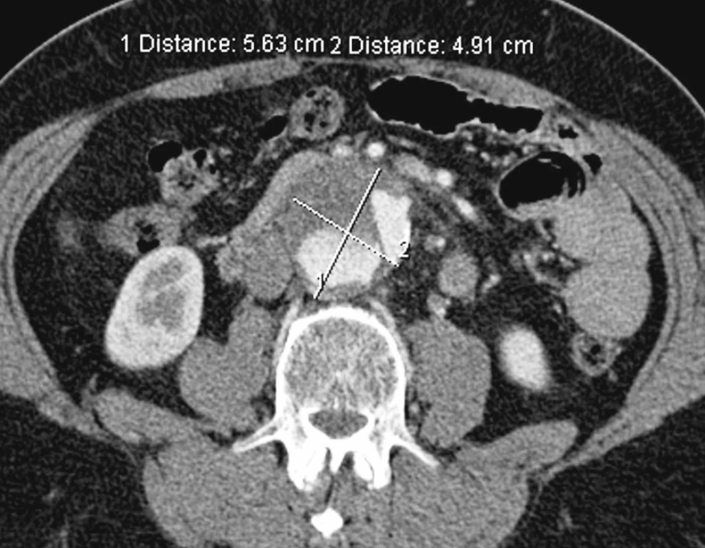 Aneuryzmatická dilatace nepravého lumen subrenálně
Pic. 15. Subrenal aneurysmatic dilation of the false lumen