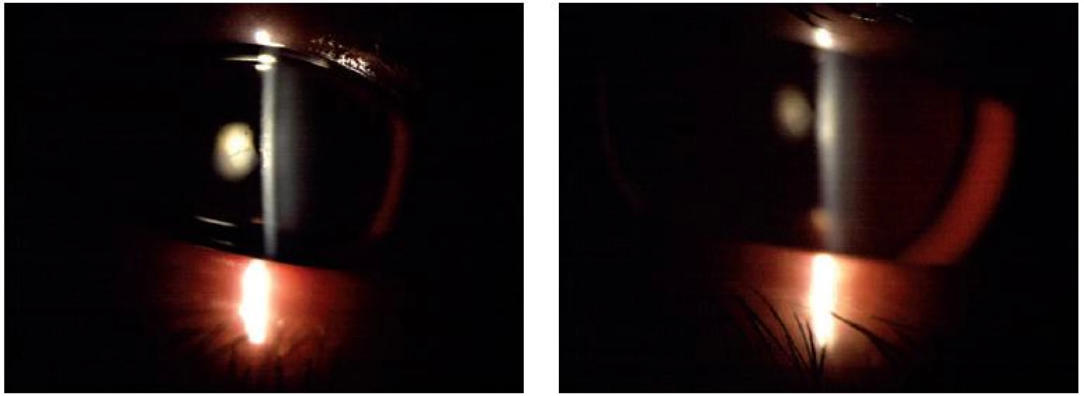 Pacient III-1: pravé (A) a levé oko (B), aniridie, viditelný ekvátor čočky, rohovkové změny minimální.