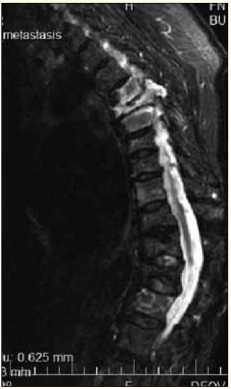 Vícečetné kompresivní fraktury hrudních obratlů při MR vyšetření, hypersignální – světlé jsou při infiltraci myelomem, tmavší jsou při osteoporóze.