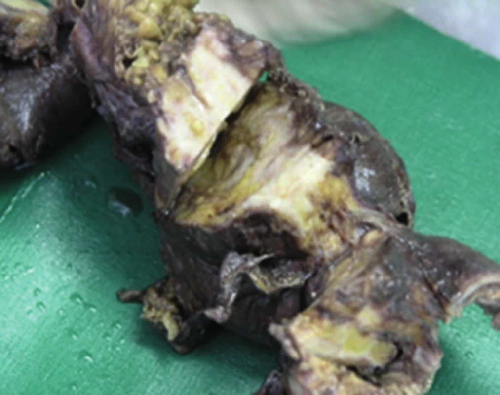 Makroskopické pitevné nálezy poukazujú na rozsah a hrúbku osifikácie zostávajúcej časti čreva
Fig. 5: Macroscopic autopsy findings indicate the extent and thickness of ossification of the residual part of the intestine