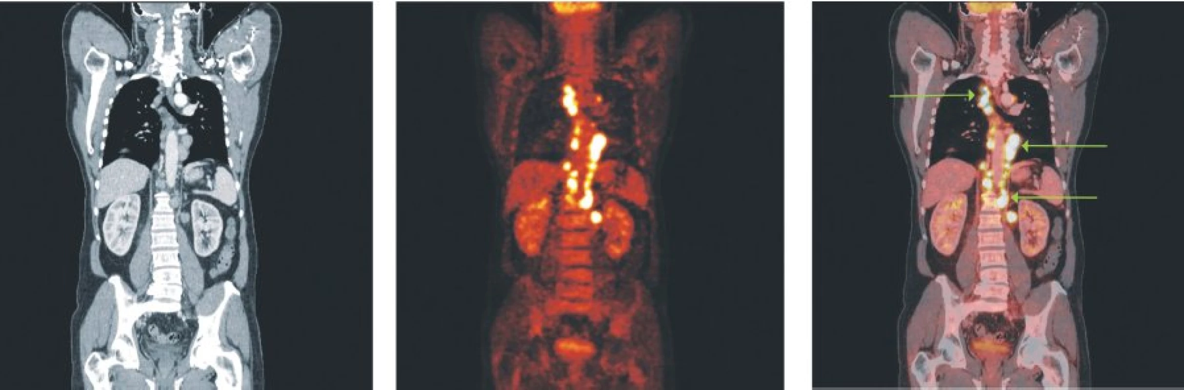 Snímky výpočetní tomografie (CT), pozitronové emisní tomografie (PET) a PET/CT u nemocného s difuzním B-velkobuněčným lymfomem a postižením lymfatických uzlin ve všech oddílech mediastina, perikardiálně a v okolí břišní aorty.