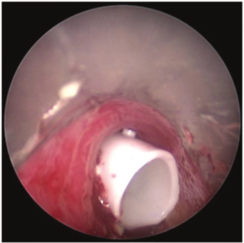 Bronchoskopický pohled: Dumonův stent v trachey
Fig. 6: Bronchoscopic view: Dumon stent in the trachea