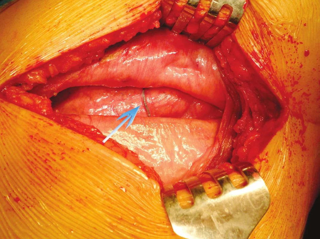 Peroperačný nález – defekt s nálezom uvoľneného perikostálneho stehu v pleurálnej dutine
