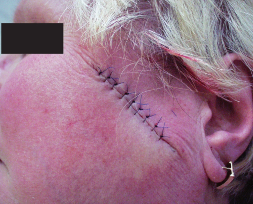 Rána uzavřená primární suturou jednoduchými uzlovými stehy.
