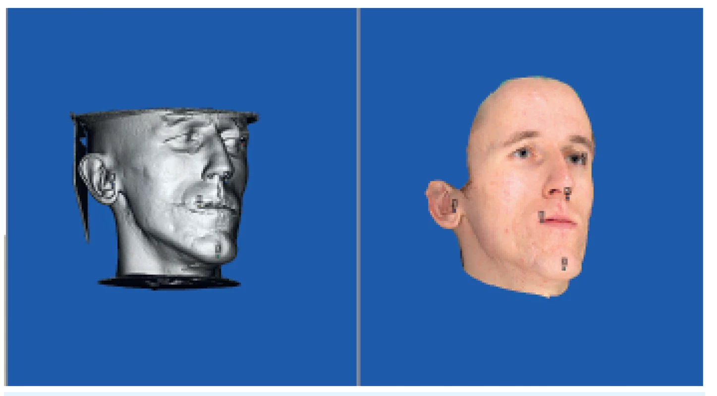 Vzájemná registrace Cone Beam CT a 3D fotografie podle nadefinovaných bodů