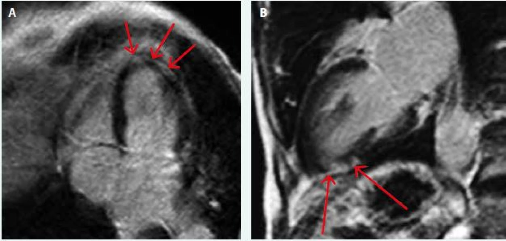 MRI nález pacienta s diagnózou akutní myokarditidy