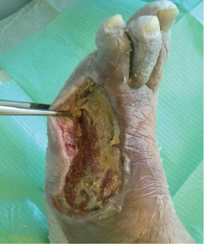 Pacient, *1938, se syndromem diabetické nohy s obnaženým metatarzo-falangeálním skloubením třetího prstu, MRSA pozitivita v defektu, v terapii instilační NPWT