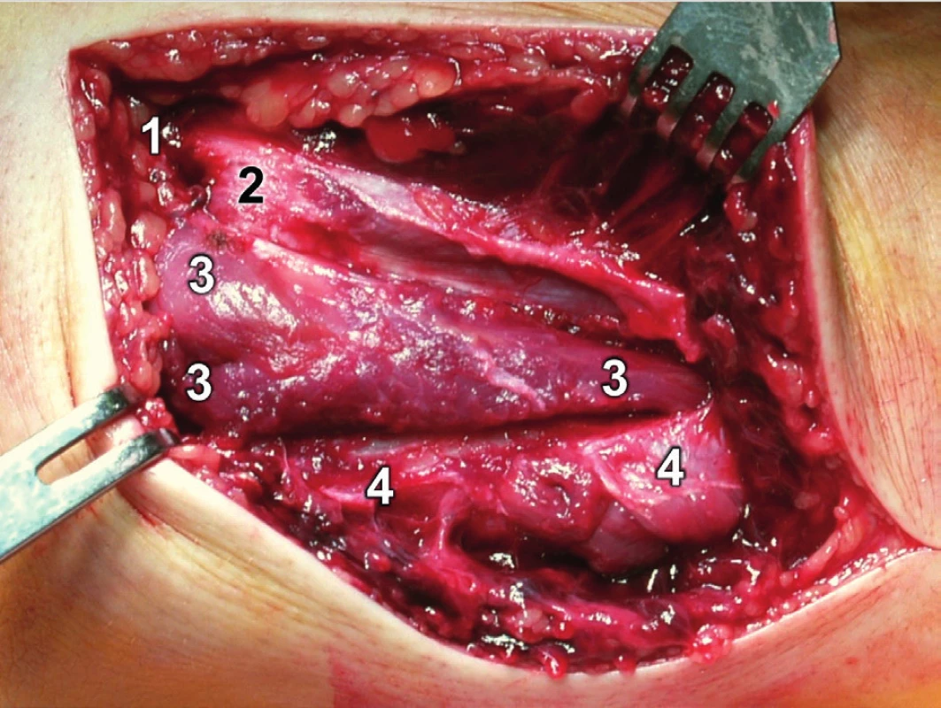 Rozšířený modifikovaný Kocherův přístup – preparace m. anconeus: 1 – epicondylus lateralis humeri, 2 – kloubní pouzdro, 3 – anconeus, 4 – ulna.
Fig. 14: Extended modified Kocher approach – dissection of anconeus: 1 – lateral epicondyle of humerus, 2 – joint capsule, 3 – anconeus, 4 – ulna.

