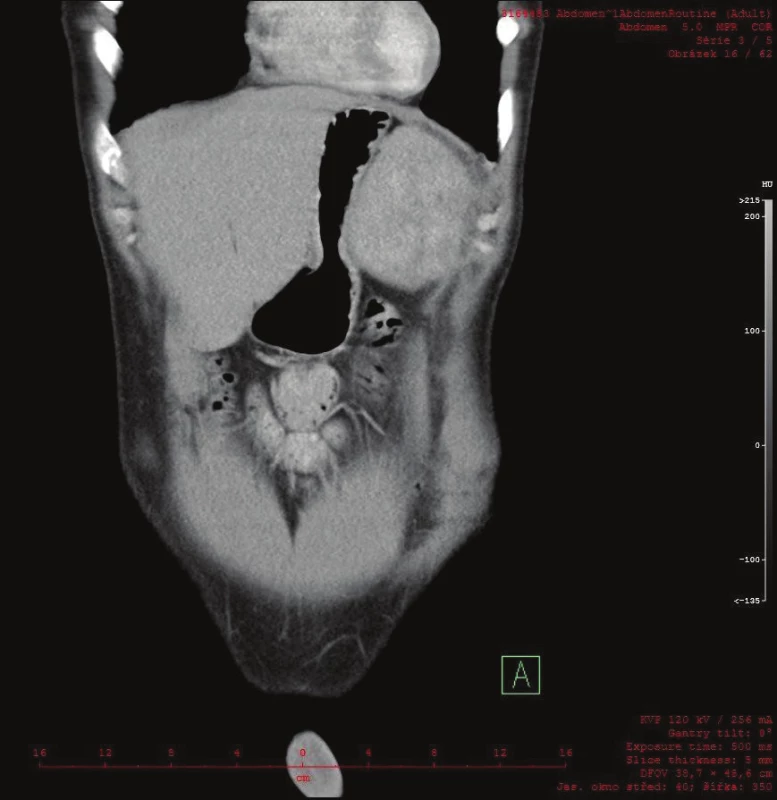 Na CT frontálním řezu je patrný útlak žaludku ložiskem v levém subfreniu
Fig. 3: A frontal CT scan showing apparent compression of the stomach by the tumor