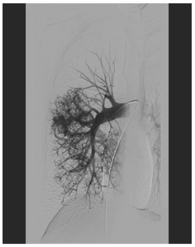 Plicní angiografie zobrazující difúzní postižení
dolního plicního laloku vpravo s mnohočetnými převážně
drobnými AV zkraty<br>
Fig. 3: Pulmonary angiography: diffuse involvement of
the right lower lobe with multiple, predominantly minor
AV shunts