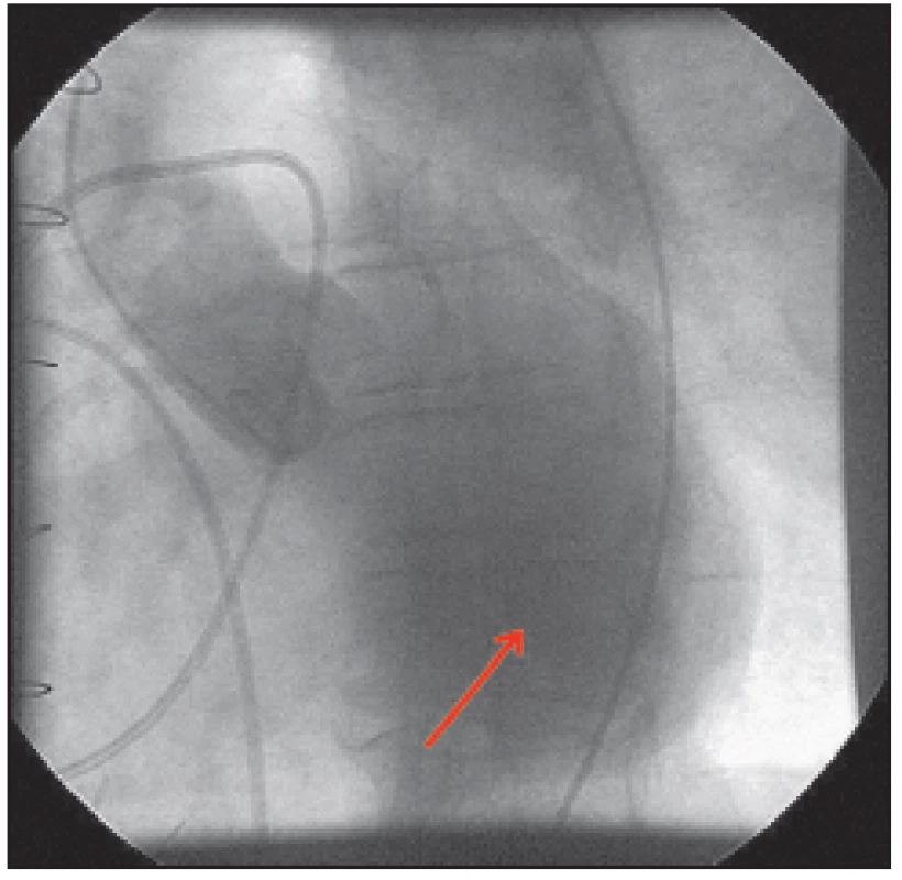 Obr. 5. Bulbografie: mohutná regurgitace kontrastní látky do levé komory širokým jetem (šipka), angiograficky aortální regurgitace 4. stupně.
