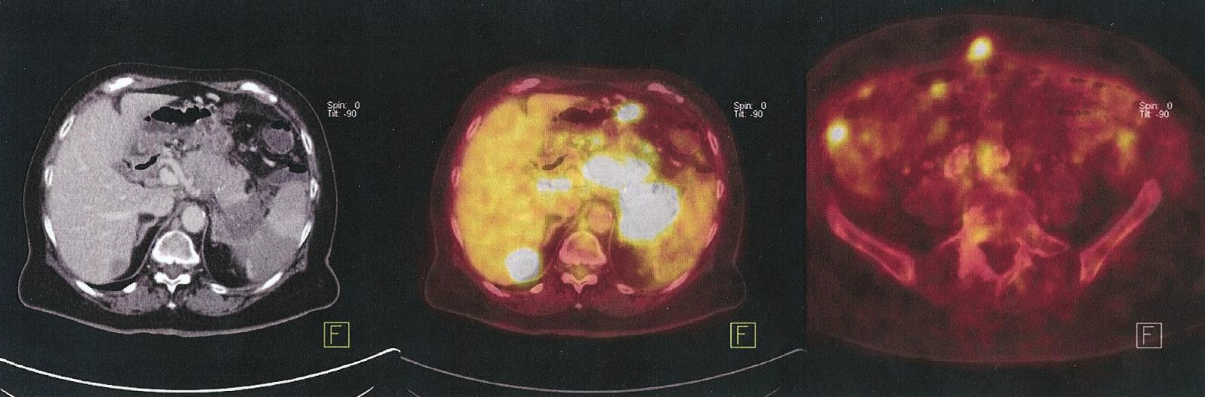Generalizovaný karcinom kaudy pankreatu s metastázami jater a peritonea, paliativní léčba
Fig. 2. Generalized pancreatic cancer of the cauda with liver and peritoneal metastases, palliative treatment