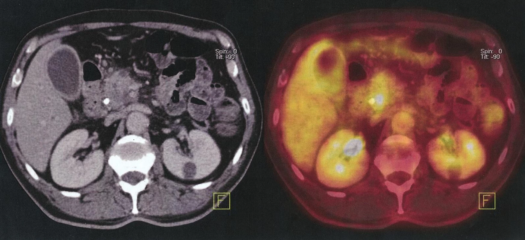 Nemocný s maligním ampulomem. Falešná pozitivita – PET/CT prokazuje metastázu jater, provedena pravostranná duodenopankreatektomie, ložisko v játrech benigní hamartom
Fig. 4. Patient with malignant ampuloma. False positive finding – PET/CT identifies liver metastases, performed right sided duodenopancreatectomy, lesion in liver is benign hamartoma