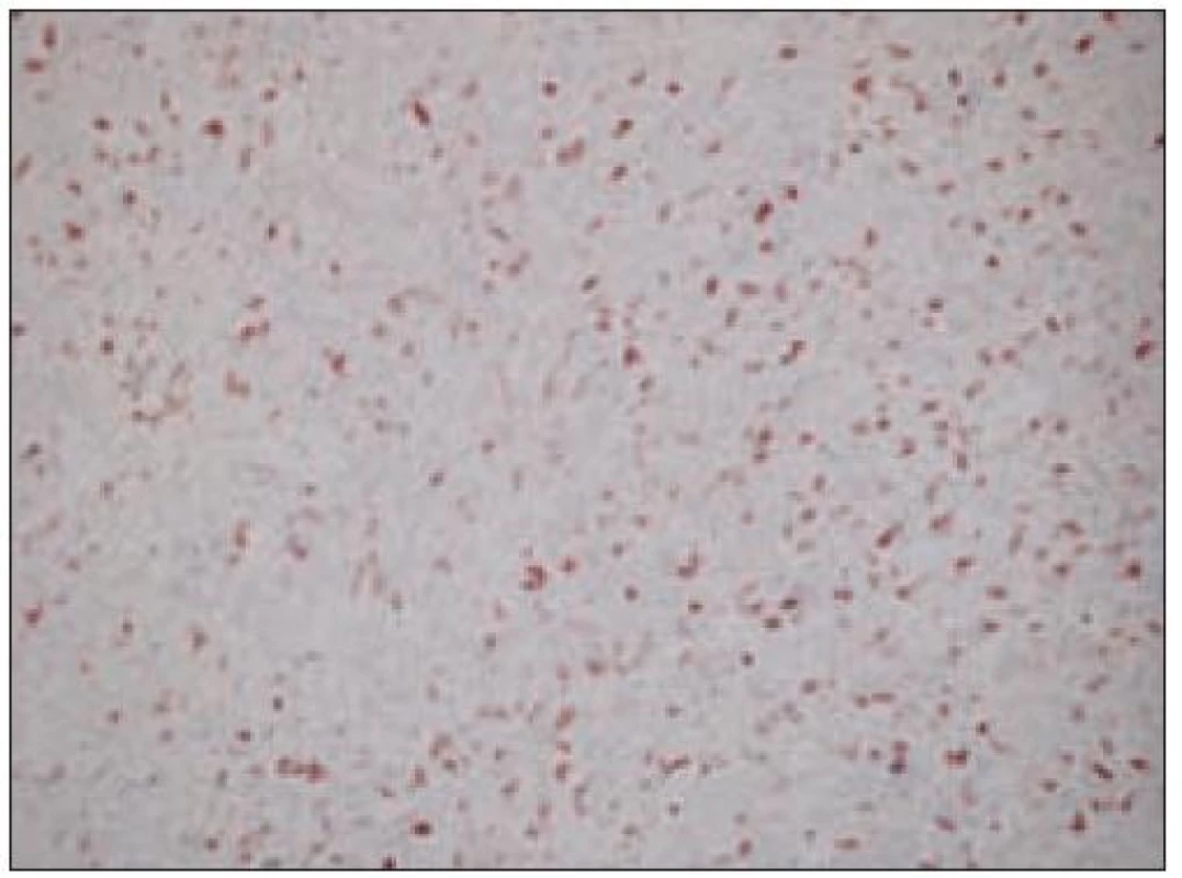 Sarkóm folikulových dendritických buniek, nízky proliferačný Ki-67 index (20krát).