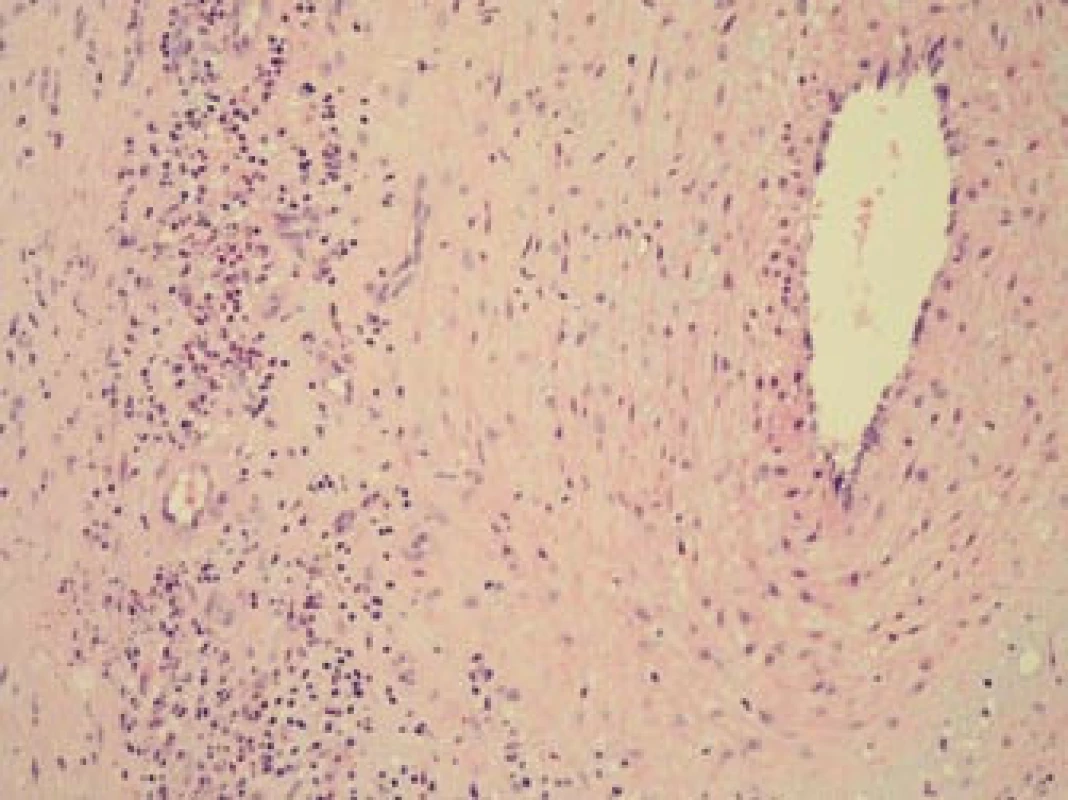 Histopatologický nález: obraz aktivního zánětu s denzním smíšeným zánětlivým infiltrátem a regresivními změnami stěny větve temporální arterie. Barvení HE, 200krát.
