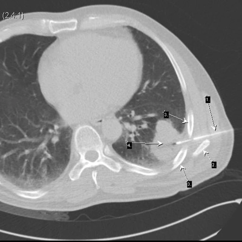 Bioptická jehla (šipka 1) probíhající v úzkém prostoru mezi skeletem žeber (šipka 3) v průběhu dolního okraje lopatky (šipka 2)
Cíleno do oblasti ložiska (šipka 4) v místě kontaktu s pleurou mimo vzdušnou plíci. Neuroendokrinní karcinom.